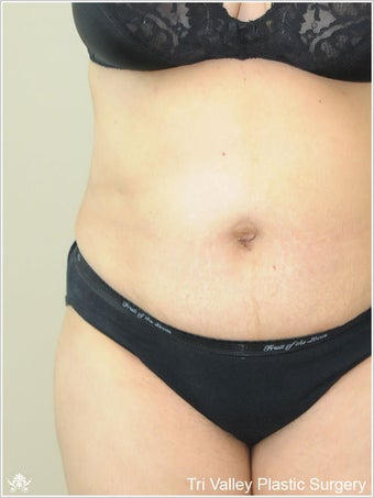 Liposuction