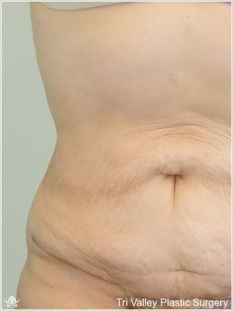 Liposuction