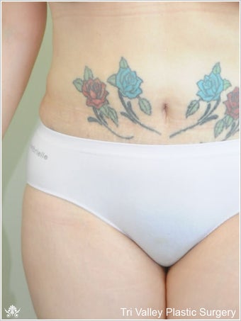 Liposuction