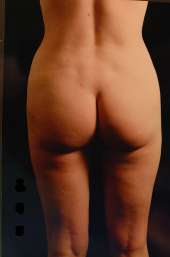 Liposuction