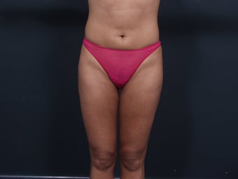 Liposuction