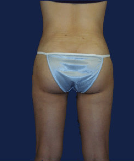 liposuction