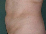 Lipo to Tummy