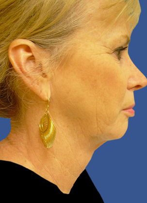 Jawline / Neck Lipo