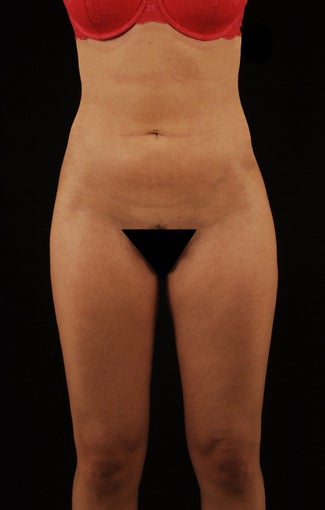 Liposuction
