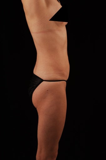 Liposuction
