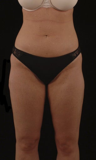Liposuction