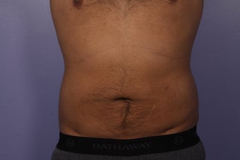 Liposuction