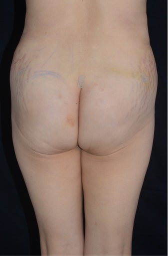 Liposuction and Abdominoplasty 