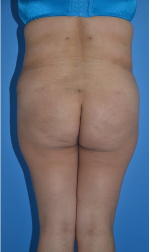 Liposuction and Abdominoplasty