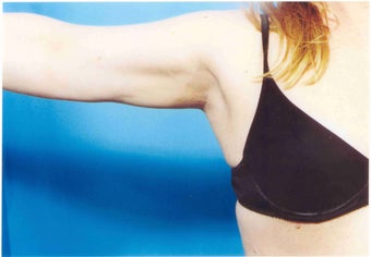 Liposuction