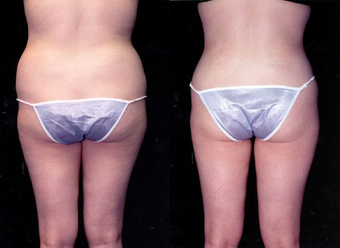Liposuction
