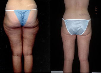 Liposuction