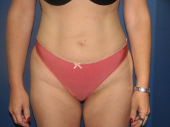 Liposuction
