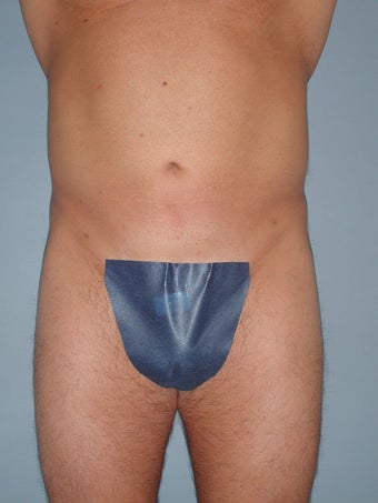 Liposuction