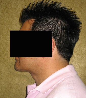 Liposuction of neck & jaw line for men