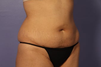 Liposuction