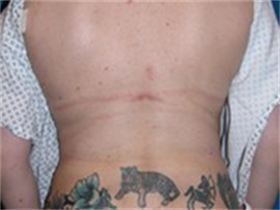 Liposuction 