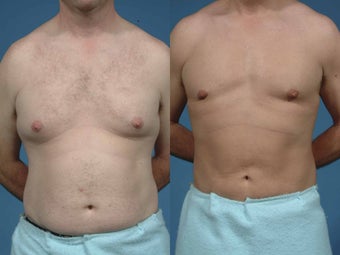 Male liposuction
