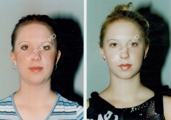 Liposuction