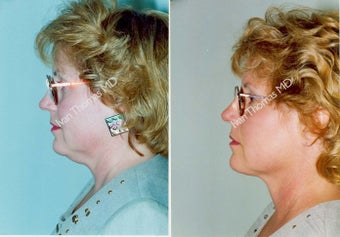 Liposuction