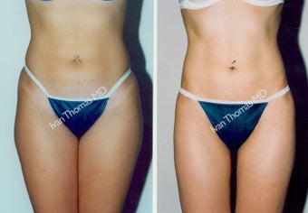 Liposuction