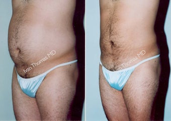 Liposuction