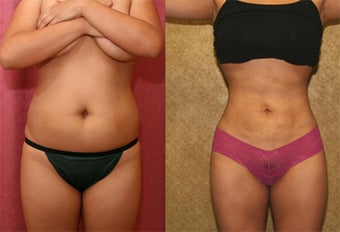 liposuction