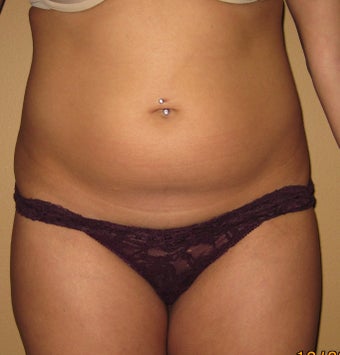 liposuction
