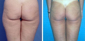 Liposuction