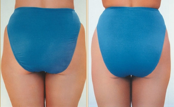Liposuction