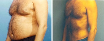 Liposuction