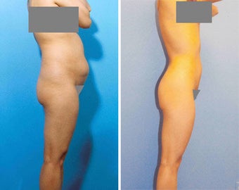 Liposuction