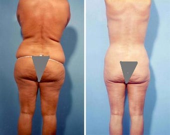 Liposuction