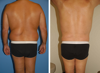 Male Liposuction