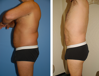 Male Liposuction