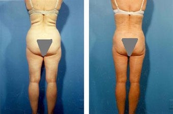 Liposuction of Back Rolls