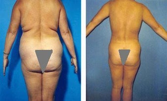 Liposuction of Back Rolls