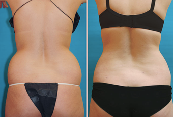 Back / Waist Lipo