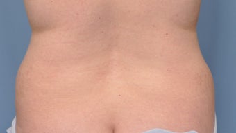 Liposuction