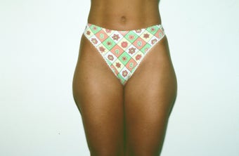 Liposuction