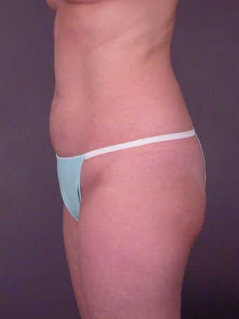 Liposuction of the hips, flanks, and thighs.
