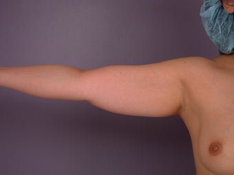 Liposuction of the arms