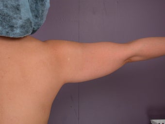 Liposuction of the arms