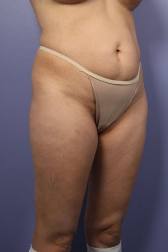 Liposuction: Thighs, Hips, and Abdomen 