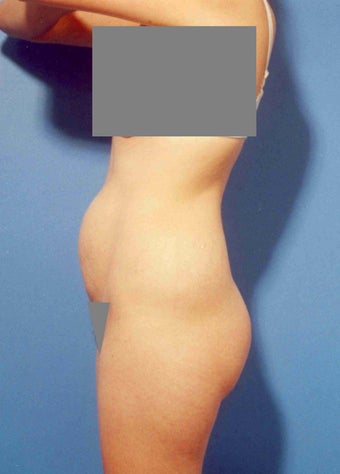 Abdominoplasty