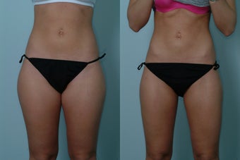 Smart Lipo