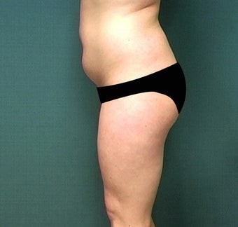 Liposuction