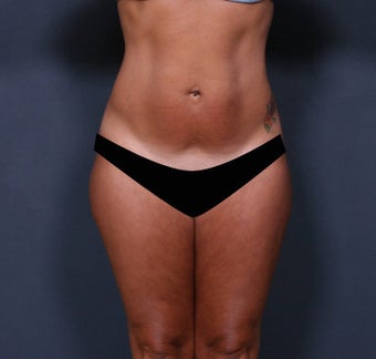 Liposuction