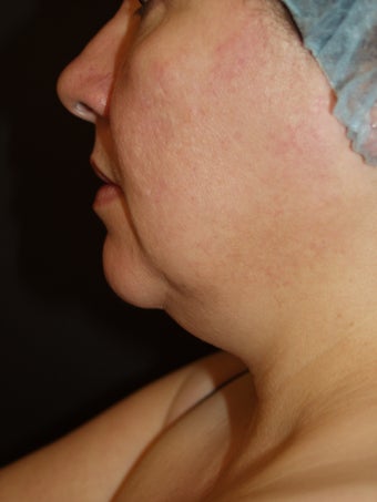 Liposuction Neck